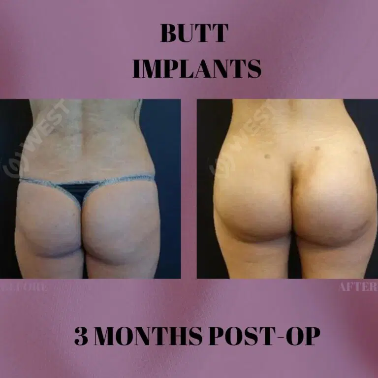 Butt Implants Turkey - Butt Implant Cost