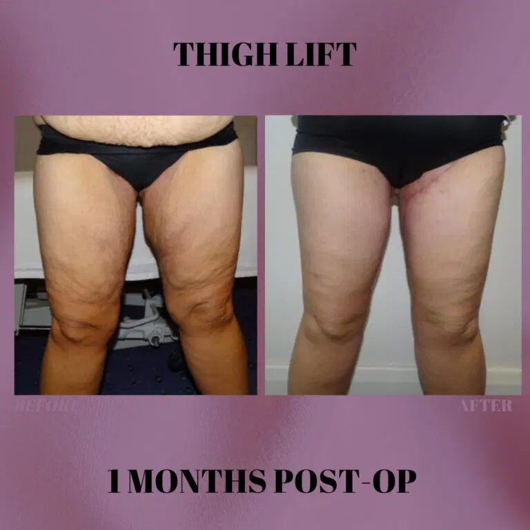 Thigh Lift Turkey - Thighplasty Cost, Recovery and Scars
