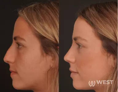 Rhinoplasty before-after