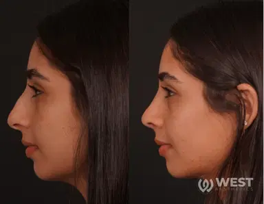 Rhinoplasty before-after