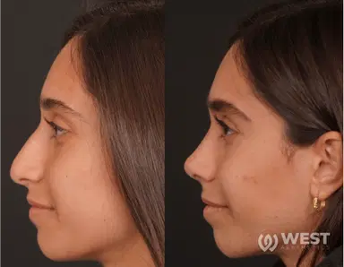 Nose Job before-after