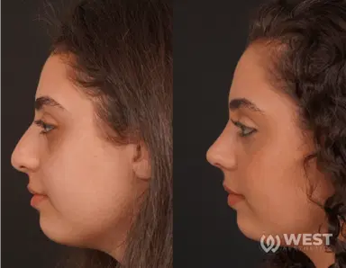 Nose Job before-after