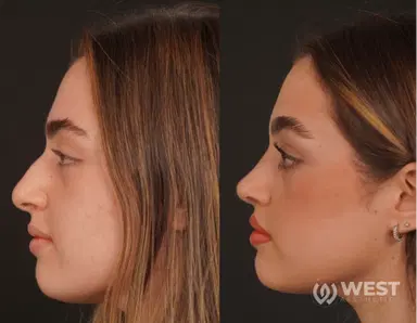 Nose Job before-after