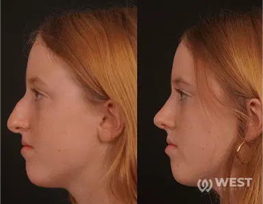 Nose Job before-after