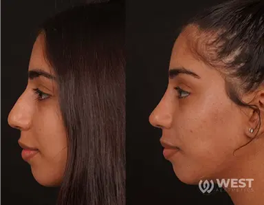 Nose Job before-after