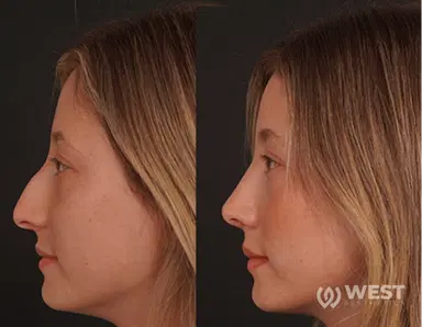 Nose Job before-after