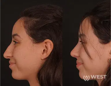 Rhinoplasty before-after