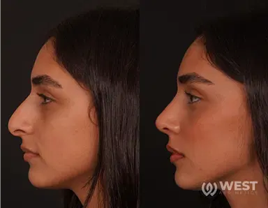 Rhinoplasty before-after