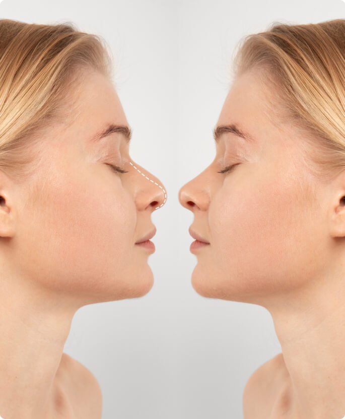 Who Can Have Rhinoplasty?