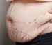 liposuction
